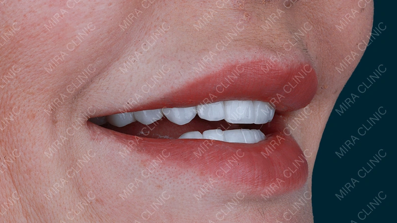 Veneers natural look 